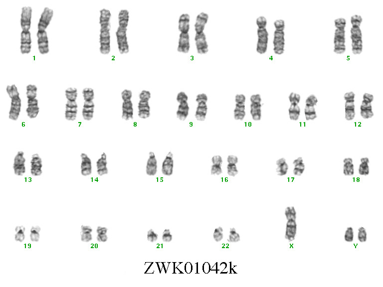 Xyy Karyotype