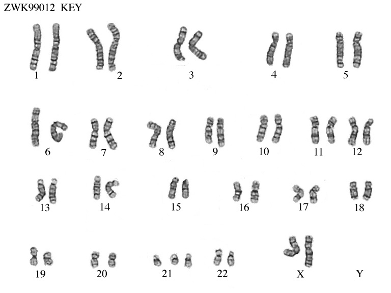 Trisomy 21 Karyotype