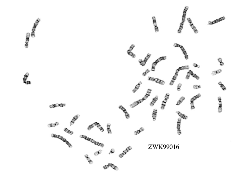 Trisomy 9 Karyotype