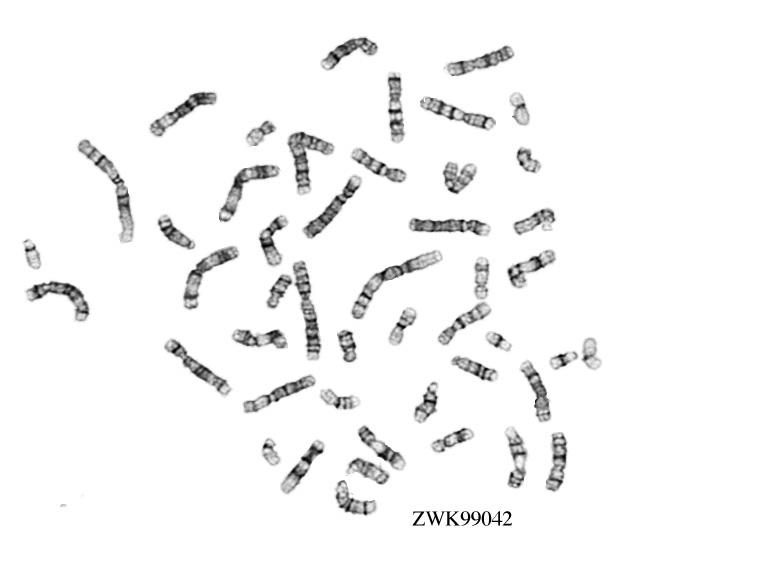 Trisomy X Karyotype