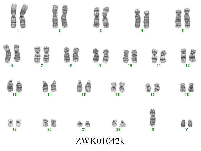 jacobs syndrome karyotype
