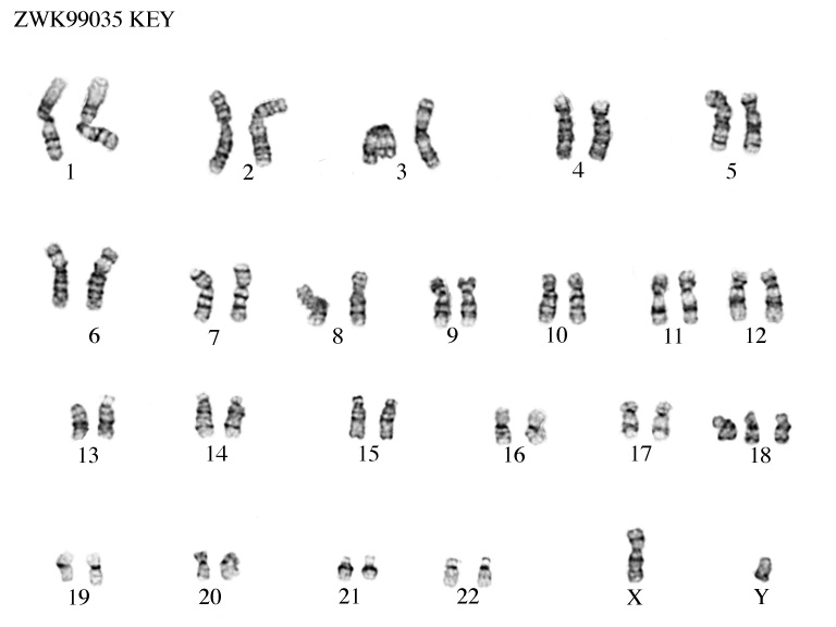 edwards syndrome chromosomes